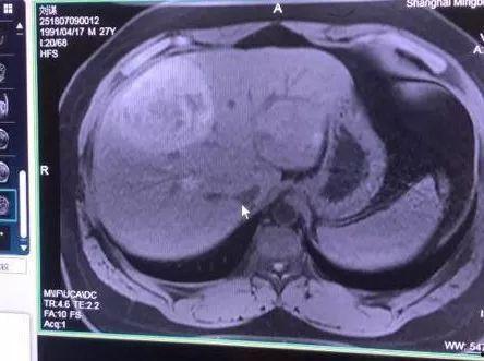 肝癌可以吃瓜了吗,瓜类食物的适宜摄入与禁忌