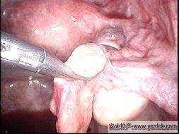 人流术后可以吃瓜么